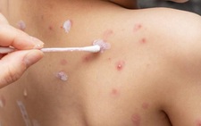 Hà Nội: Một huyện xuất hiện 5 ổ dịch thủy đậu