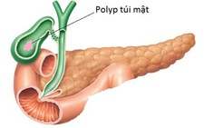 Chủ quan polyp túi mật lành tính, cẩn thận nguy hiểm
