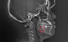 Bệnh nhân phản ánh nhổ răng khôn để ‘quên’ mũi khoan, bệnh viện nói gì?