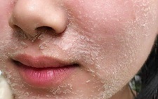 Trào lưu làm đẹp peel da tại nhà có an toàn?
