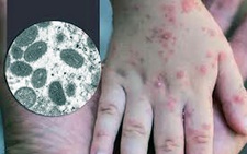 Ghi nhận ca bệnh đậu mùa khỉ đầu tiên ở Đồng Nai