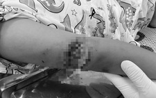 Sang nhà hàng xóm chơi, bé gái bị chó cắn thấu xương cánh tay