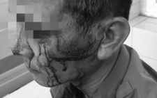 Bảo vệ Bệnh viện K bị ‘cò nhà trọ’ đeo ‘tay gấu’ kim loại hành hung nhập viện