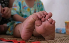 Ho Chi Minh City detects return of EV71 as severe hand, foot and mouth cases rise