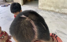 Vụ học sinh lớp 3 bị xe tông tổn thương 90%: Tòa án mời các bên liên quan làm việc lần hai