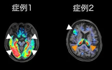 Middle- to old-age depression likely tied to dementia