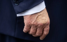 Trump diagnosed with vein issue after leg swelling and hand bruising
