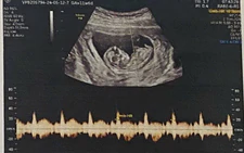 In Vietnam, revealing fetal gender is illegal except in these cases