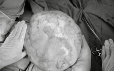 Vietnamese teen girl undergoes surgery to remove 4.3kg ovarian tumor with teeth, hair, bone