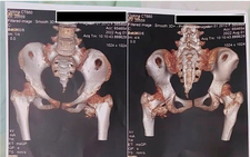 Rare stone man syndrome diagnosed in 12-year-old girl in Ho Chi Minh City