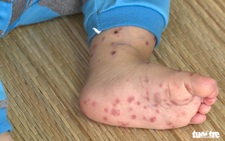 Two children die of dengue, HFMD in Vietnam’s Mekong Delta province