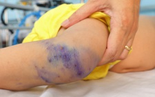 5-year-old child dies of suspected HFMD in Ho Chi Minh City