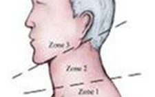 Thoái hóa đốt sống cổ, điều trị thế nào?