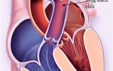 Dị tật tim bẩm sinh 