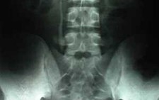Vôi cột sống