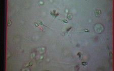 Nhiều thắc mắc về... màu của tinh dịch