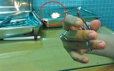 Ù tai do cục ráy tai quá lớn