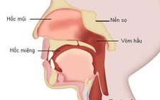 Ung thư vòm họng