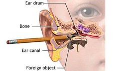 Thủng màng nhĩ không phải điếc hoàn toàn