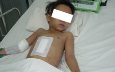Cứu sống một trẻ sốt xuất huyết có xuất huyết tiêu hóa nặng