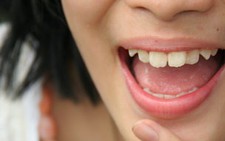 Giữ vệ sinh răng miệng để ngừa ung thư