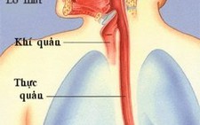 Polyp thực quản lành tính