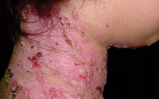 Những ca da liễu hiếm gặp