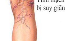 Suy giãn tĩnh mạch chân