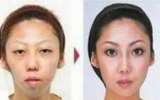 Vợ bị chồng kiện vì... giấu chuyện phẫu thuật thẩm mỹ