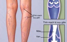 Suy giãn tĩnh mạch chân