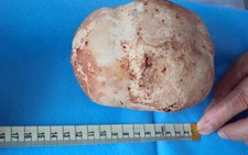 Sỏi bàng quang nặng gần 1kg