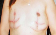 Những vụ tử vong, tai biến nghiêm trọng tại thẩm mỹ viện