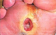 Bảo vệ bàn chân bệnh nhân tiểu đường