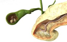 ​Sức khoẻ của bạn: Hiểu về bệnh sỏi mật