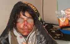 ​Người Afghanistan phẫn nộ vì chồng cắt mũi vợ