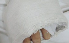 Cứu một bàn tay bị đứt lìa
