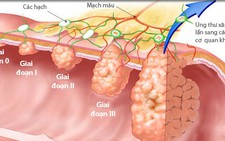 Sáu bí quyết giảm nguy cơ ung thư đại tràng
