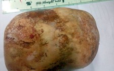 Mổ lấy sỏi bàng quang nặng 1,5kg