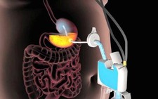 Thiết bị hút thức ăn ra khỏi dạ dày để giảm cân