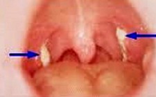 Mắc bệnh bạch hầu, 3 người chết