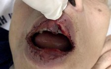 Cần xử nghiêm vụ cựu giảng viên đại học bị đánh