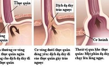 ​Trào ngược dạ dày thực quản: những điều cần biết