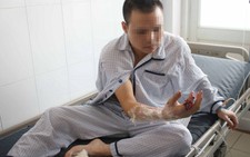 Phẫu thuật nối thành công ngón tay bị máy xay thịt cắt lìa