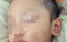 ​Điều tra nghi vấn bé trai 2 tuổi bị bạn trai của mẹ bạo hành