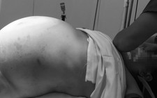 Mổ thành công khối u gần 20kg