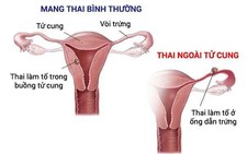 ​Những biểu hiện khi bị thai ngoài tử cung
