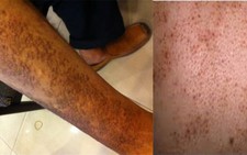 ​Bệnh viêm nang lông và cách điều trị