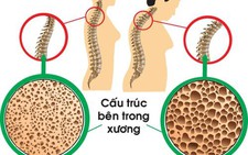 ​Phòng tránh loãng xương ở người cao tuổi
