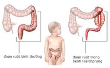 Trẻ sơ sinh bị táo bón có đáng lo?