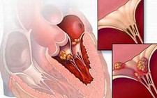 ​Đau tim từ... viêm họng